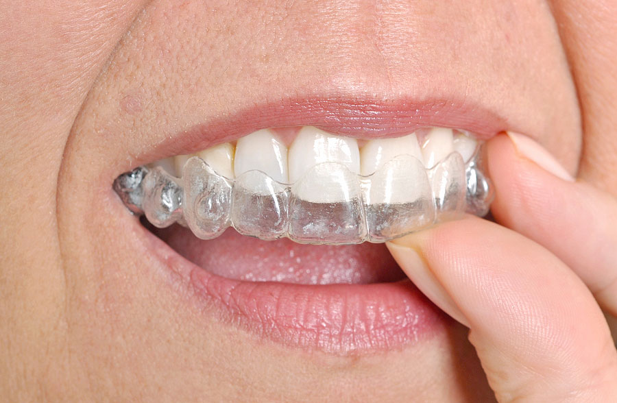 The Cost of Invisalign in Fairfax