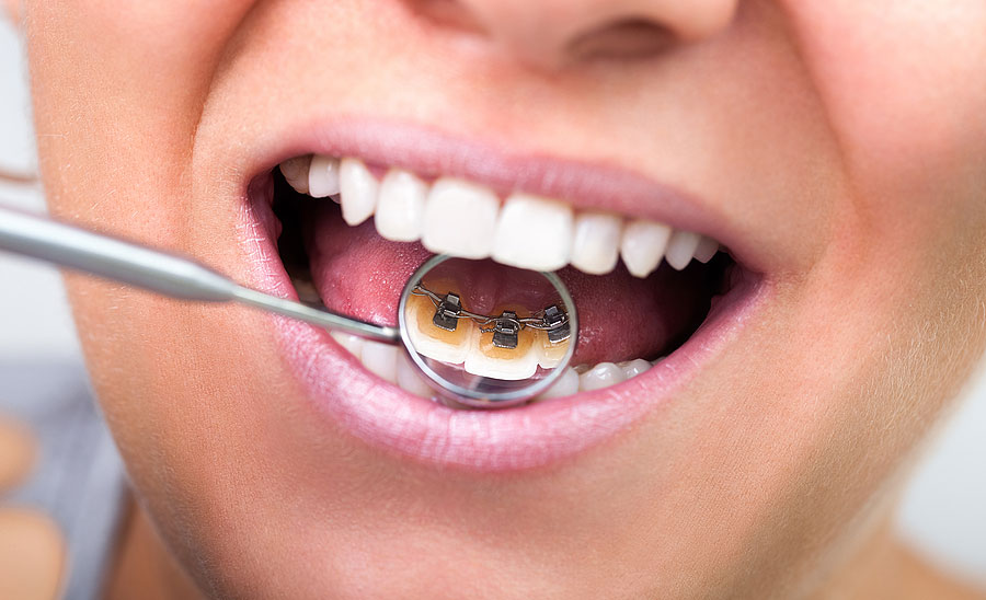 What’s the Difference between Plaque and Tartar – and Why Should I Care?